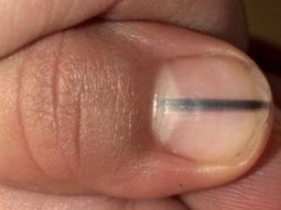 the-important-reason-why-this-photo-of-a-fingernail-has-gone-viral