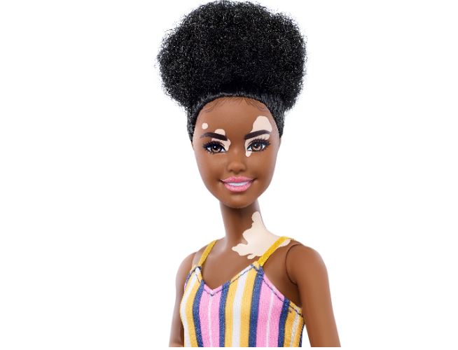 vitiligo barbie