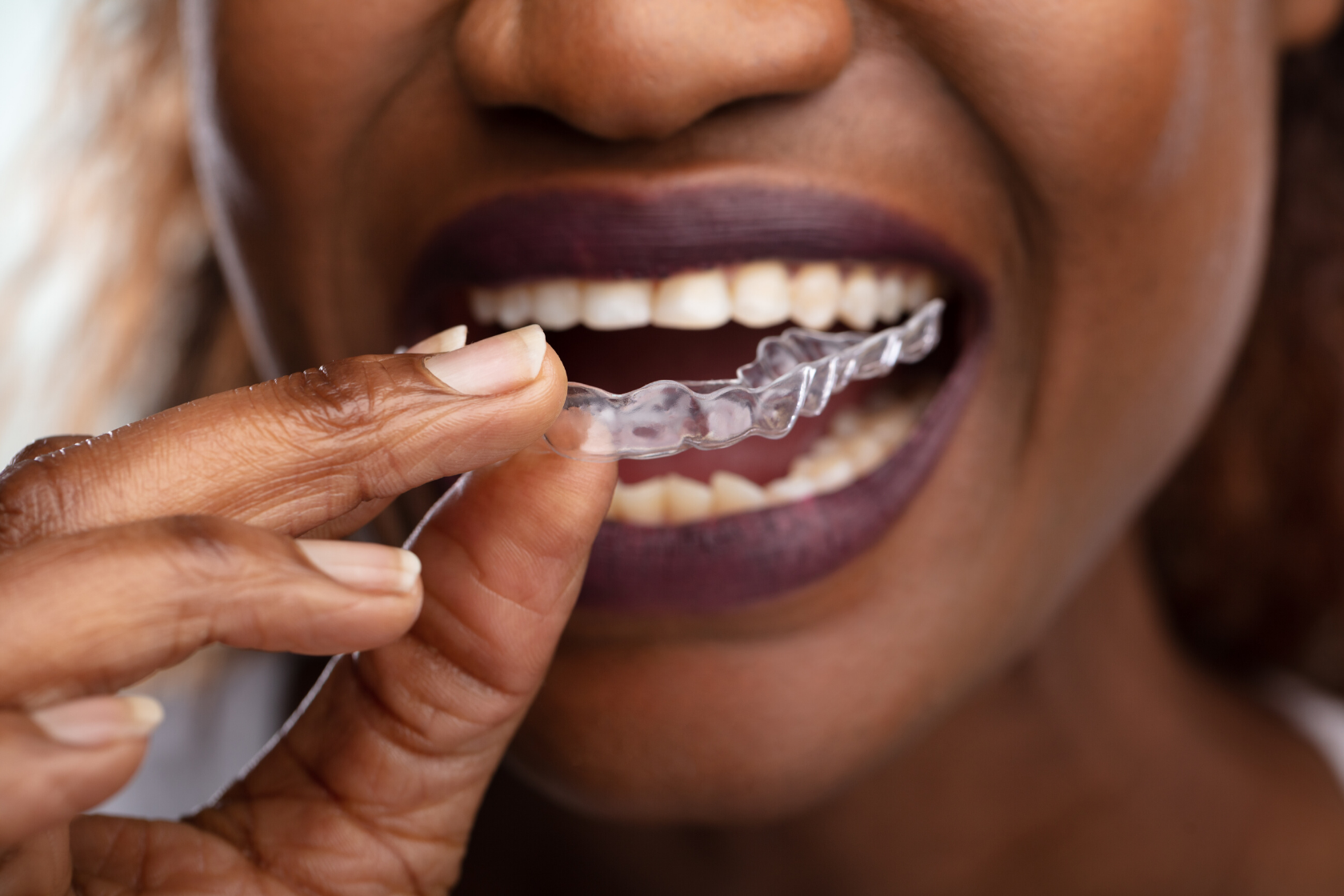 Invisalign Treatment Process: How It Works