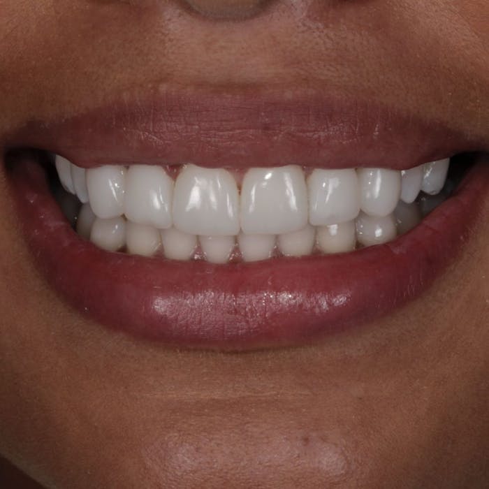 Teeth composite bonding everything to know, from cost to care